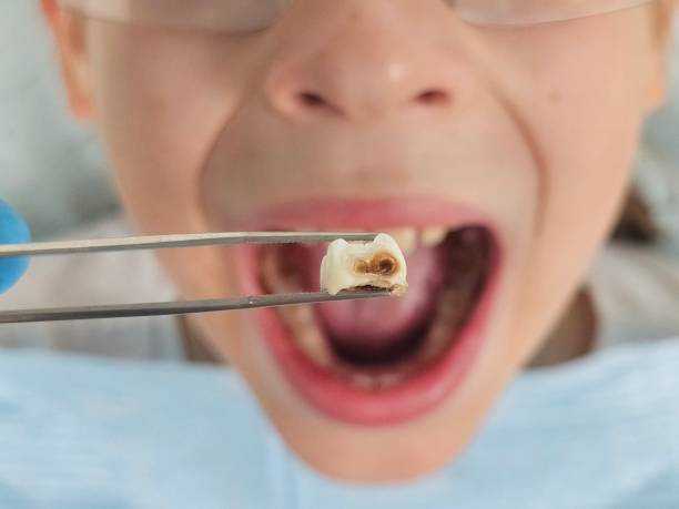 Best Emergency Dental Extractions in Cloverleaf, TX